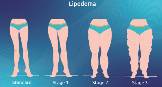 Understanding Lipoedema: Facts and Figures